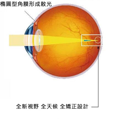 全功能三合一人工水晶體