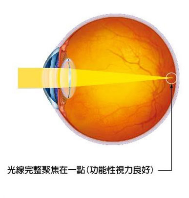 透視明非球面人工水晶體