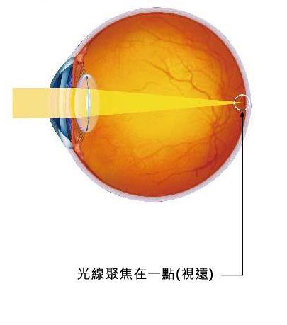 單焦點人工水晶體