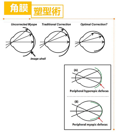 角膜塑形術