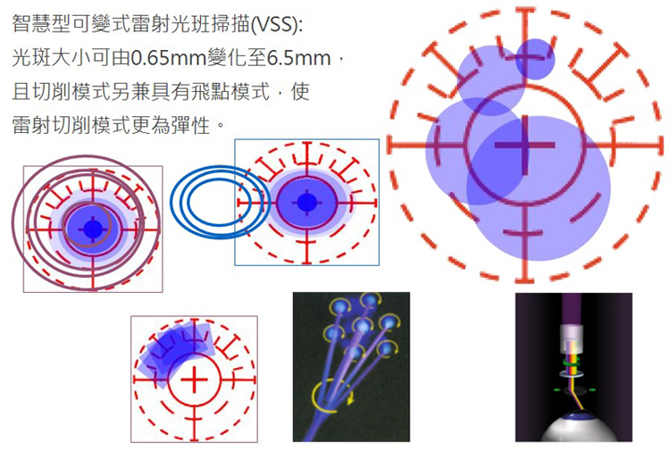 高效率角膜切削-智慧變形光斑掃描