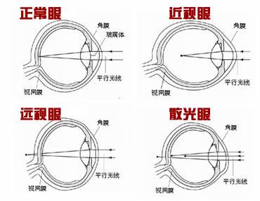 近視、遠視、散光