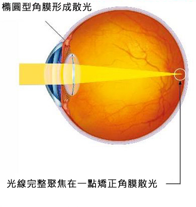 全功能三合一人工水晶體