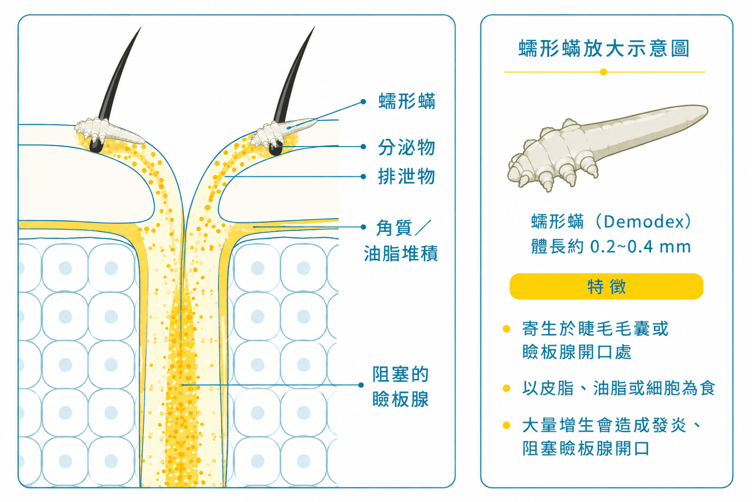 蠕形蟎蟲與瞼板腺功能障礙之關係