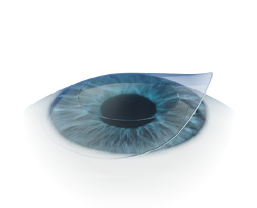SMART TransPRK後戴上隱形眼鏡保護