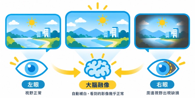 青光眼大腦自動補白缺損視野