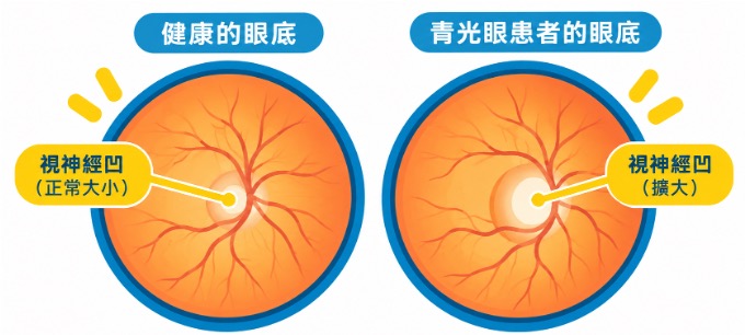 青光眼視神經損傷